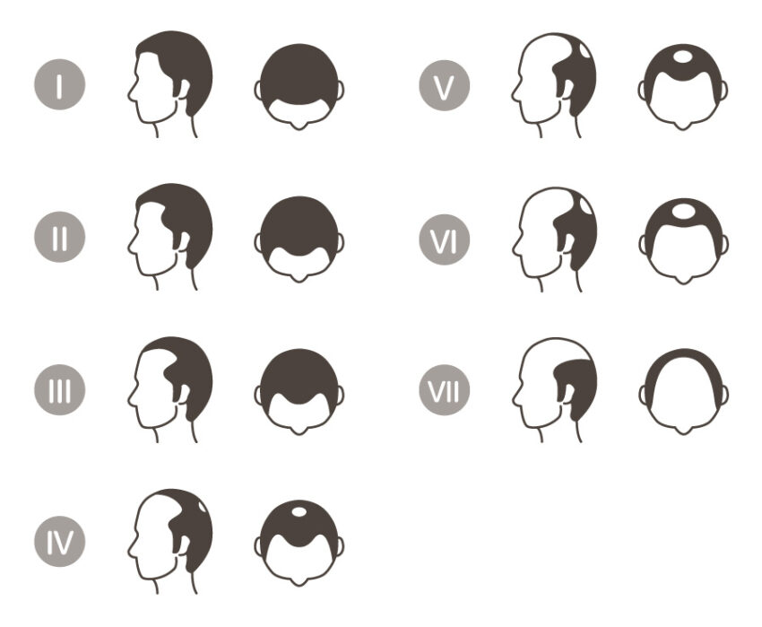 これってAGA？おでことM字はげの見分け方